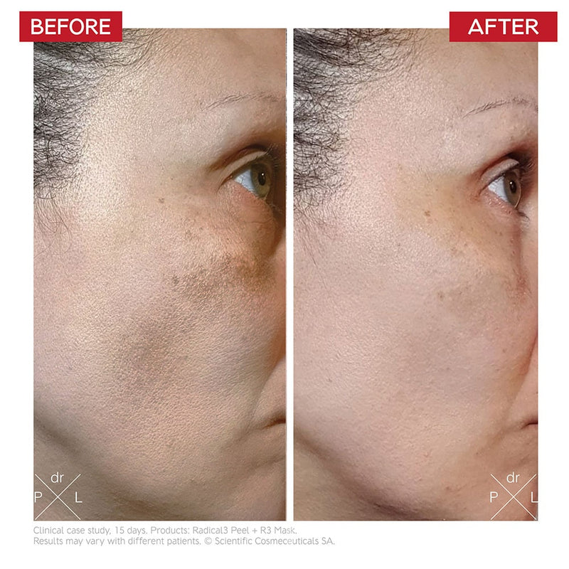 Dr Levy - Radical3 Reboot Pro Peel 50ml